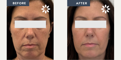 Case 9708 - 55-64 year old woman treated with Halo Laser