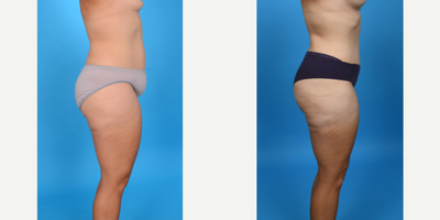 Case 971 - 35-44 year old woman treated with Abdominal Etching, Diastasis Recti Repair, Drainless Tummy Tuck, Liposculpture, Liposuction, M