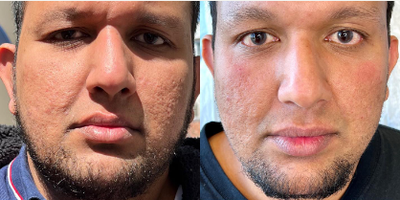Case 9714 - Man treated with TCA Peel, Halo Laser, CO2 Laser