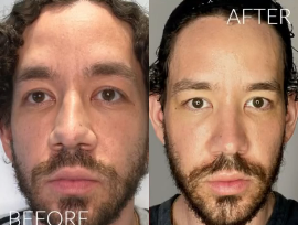 Case 9718 - Man treated with Halo Laser, PRP Injections