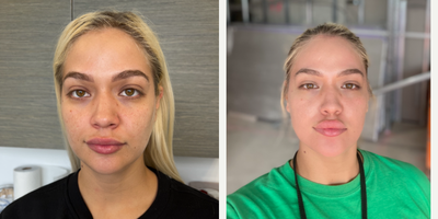 Case 9719 - 25-34 year old woman treated with Halo Laser