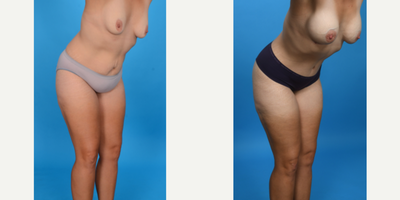 Case 972 - 35-44 year old woman treated with Abdominal Etching, Diastasis Recti Repair, Drainless Tummy Tuck, Liposculpture, Liposuction, M