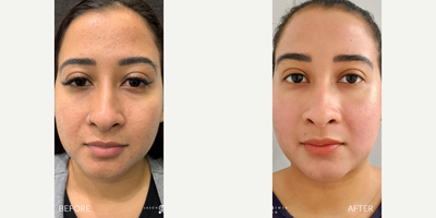 Case 9721 - Woman treated with Halo Laser, ProFractional Laser