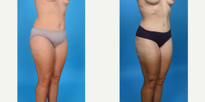 Case 973 - 35-44 year old woman treated with Abdominal Etching, Diastasis Recti Repair, Drainless Tummy Tuck, Liposculpture, Liposuction, M