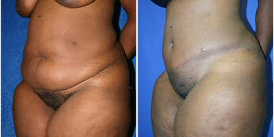 Case 975 - Woman treated with Tummy Tuck