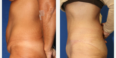 Case 976 - Woman treated with Tummy Tuck