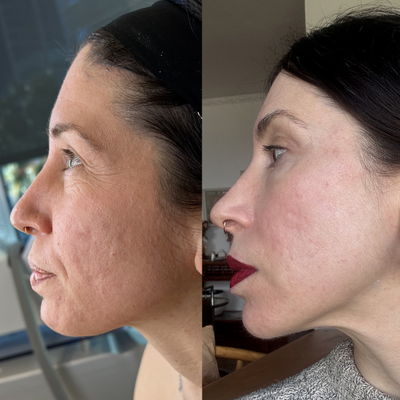 Case 9767 - 25-34 year old woman treated with CO2 Laser, Halo Laser, Microneedling RF, Subcision