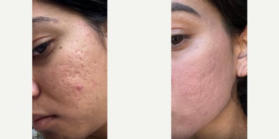Case 9768 - Acne scars dont stand a chance.