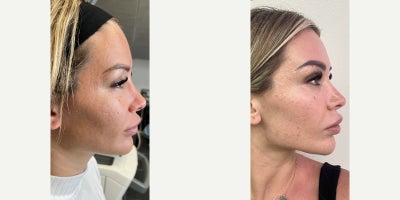 Case 9769 - 25-34 year old woman treated with Halo Laser, ProFractional Laser