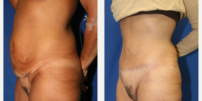 Case 977 - Woman treated with Tummy Tuck