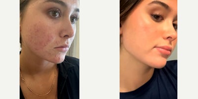 Case 9770 - 17 or under year old woman treated with Halo Laser, Microneedling RF, Accutane