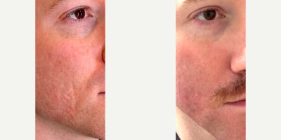 Case 9771 - 25-34 year old man treated with Halo Laser, CO2 Laser, Microneedling RF, Silikon 1000