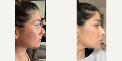 Case 9772 - 18-24 year old woman treated with Phenol Peel, Halo Laser