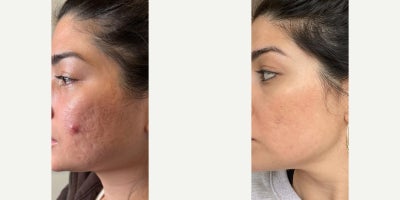 Case 9773 - 18-24 year old woman treated with Phenol Peel, Halo Laser