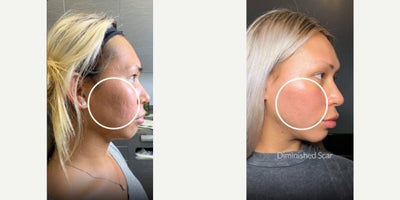 Case 9776 - 18-24 year old woman treated with Subcision, Bellafill, Halo Laser, CO2 Laser