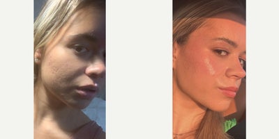 Case 9777 - 18-24 year old woman treated with Halo Laser, Microneedling RF