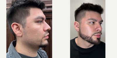 Case 9778 - Acne Scar Treatment Transformation | Confidence Restored