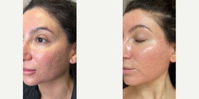 Case 9779 - 25-34 year old woman treated with Halo Laser, Bellafill, CO2 Laser