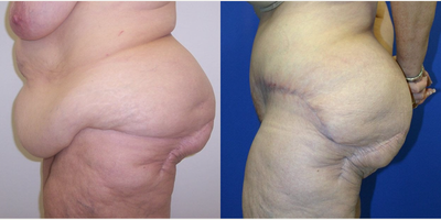 Case 978 - Woman treated with Tummy Tuck