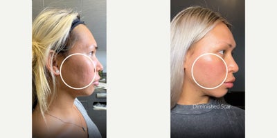 Case 9781 - 25-34 year old woman treated with Subcision, Bellafill, Halo Laser, CO2 Laser