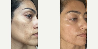 Case 9782 - 25-34 year old woman treated with Halo Laser