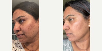 Case 9783 - 35-44 year old woman treated with Halo Laser