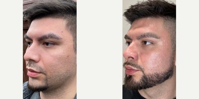 Case 9784 - 18-24 year old man treated with Halo Laser, CO2 Laser