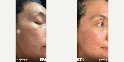 Case 9785 - Woman treated with Bellafill, Halo Laser, CO2 Laser