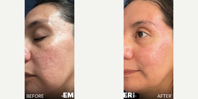 Case 9786 - Woman treated with Bellafill, Halo Laser, CO2 Laser