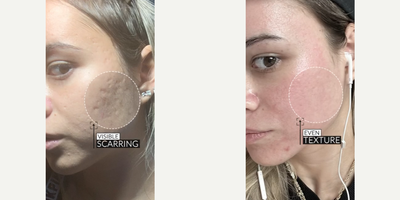 Case 9787 - Woman treated with Halo Laser, Microneedling RF