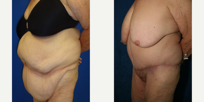 Case 979 - Woman treated with Tummy Tuck