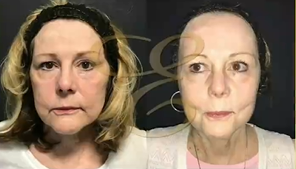 Case: 9790 - before and after photo of Woman treated with Laser Resurfacing by Vivek Bansal, MD