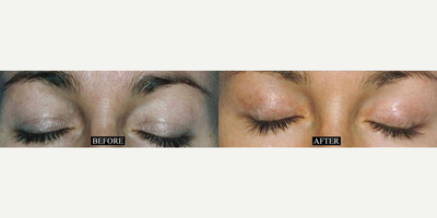 Case: 9791 - before and after photo of Woman treated with Laser Resurfacing by Barry M. Weintraub, MD, FACS