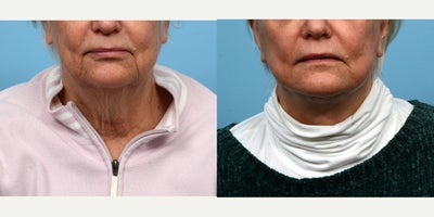 Case: 9792 - before and after photo of 65-74 year old woman treated with Facelift, Lower Facelift, Neck Lift, SMAS Facelift, CO2 Laser, Laser Resurfacing by Jeffrey B. Wise, MD, FACS