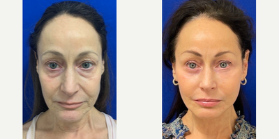 Case: 9793 - before and after photo of 56 year old woman treated with Laser Resurfacing by Dilip D. Madnani, MD, FACS