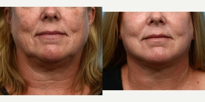 Case: 9794 - before and after photo of 65-74 year old woman treated with Laser Resurfacing by Jeffrey B. Wise, MD, FACS