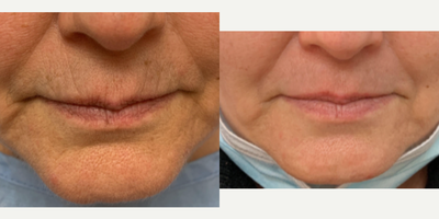 Case: 9795 - before and after photo of 55-64 year old woman treated with Laser Resurfacing by Franklin D. Richards, MD