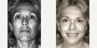 Case: 9796 - before and after photo of Woman treated with Laser Resurfacing by Barry M. Weintraub, MD, FACS