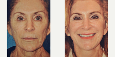 Case: 9797 - before and after photo of Woman treated with Laser Resurfacing by Barry M. Weintraub, MD, FACS