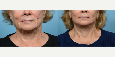 Case 9798 - 65-74 year old woman treated with Laser Resurfacing