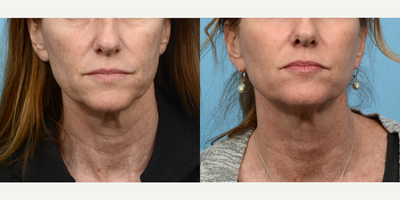 Case 9799 - 45-54 year old woman treated with Laser Resurfacing
