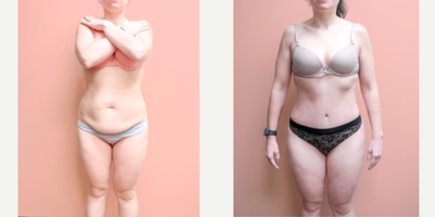 Case 98 - 35-44 year old woman treated with Tummy Tuck, Liposuction