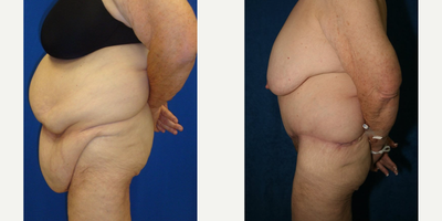 Case 980 - Woman treated with Tummy Tuck