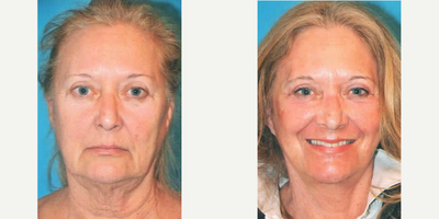 Case 9800 - Woman treated with Laser Resurfacing