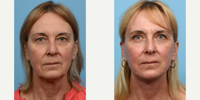 Case 9801 - 55-64 year old woman treated with Laser Resurfacing