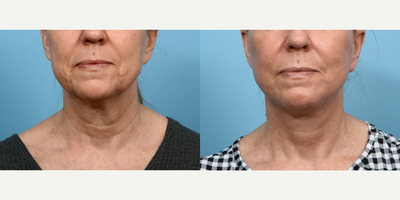 Case 9804 - 55-64 year old woman treated with Laser Resurfacing