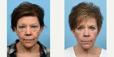 Case 9805 - 45-54 year old woman treated with Laser Resurfacing