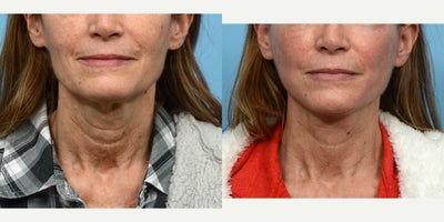Case 9806 - 45-54 year old woman treated with Laser Resurfacing