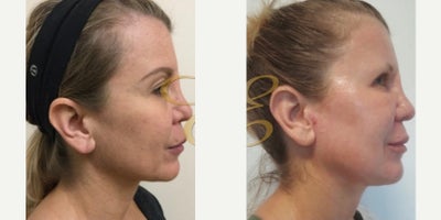 Case 9809 - Woman treated with Laser Resurfacing
