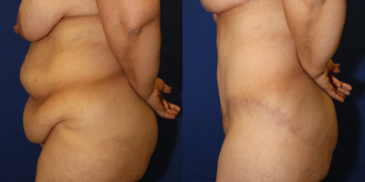 Case 981 - 35-44 year old woman treated with Tummy Tuck